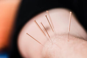 acupuncteur à Bourgoin-Jallieu