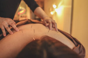 acupuncture