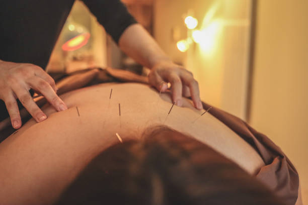 acupuncture