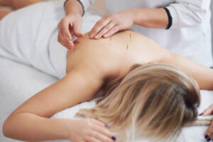 acupuncture
