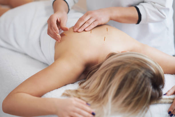 acupuncture